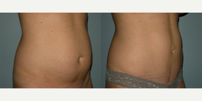 Tummy Tuck before and after photo