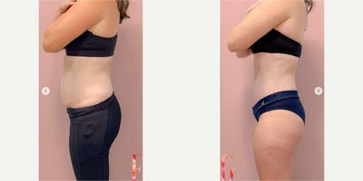 Tummy Tuck before and after photo