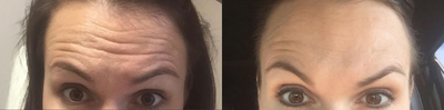 Botox before and after photo