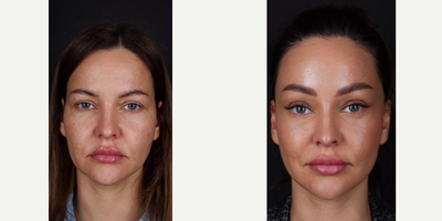 Brow Lift before and after photo