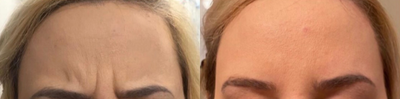 Dysport before and after photo