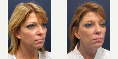 Facelift before and after photo
