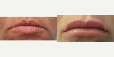Lip Fillers before and after photo