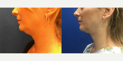 Liposuction before and after photo