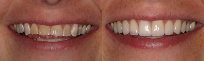 Porcelain Veneers before and after photo