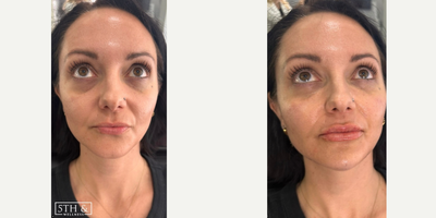 Chin Filler before and after photo