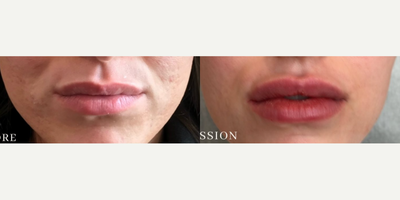 Dermal Fillers before and after photo