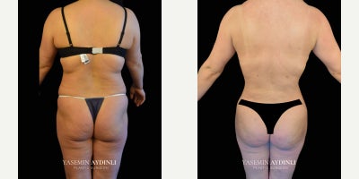 Diastasis Recti Repair before and after photo