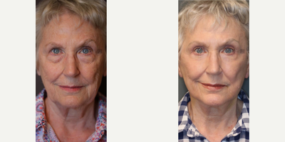 Fractional Laser before and after photo