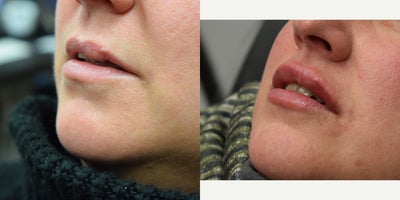 Lip Fillers before and after photo