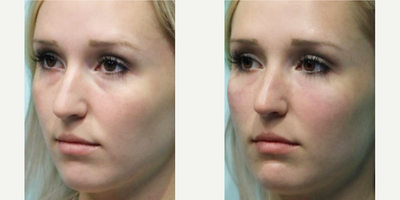Volbella before and after photo