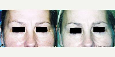 Botox before and after photo