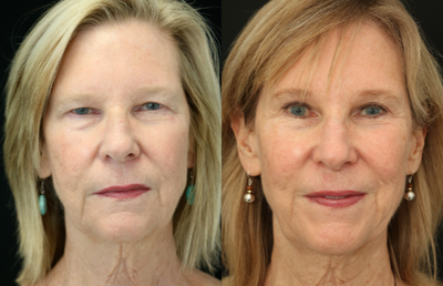 Brow Lift before and after photo