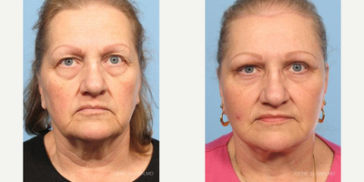 Facelift before and after photo