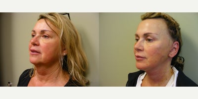 Facelift before and after photo