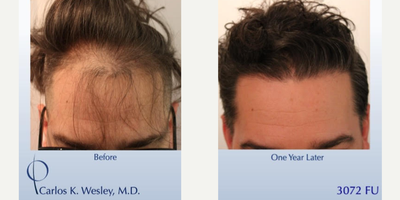 FUE Hair Transplant before and after photo