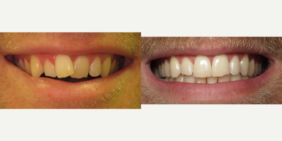 Invisalign before and after photo