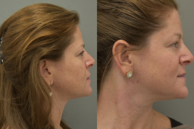 Rhinoplasty before and after photo