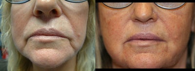 ArteFill before and after photo