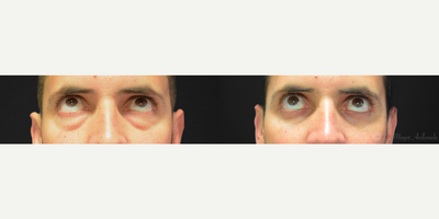 Eyelid Surgery before and after photo