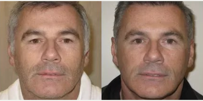 Facelift before and after photo