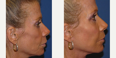 Facial Fat Transfer before and after photo