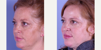 Laser Resurfacing before and after photo