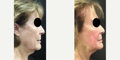 Thread Lift before and after photo