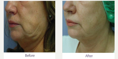 Ultherapy before and after photo
