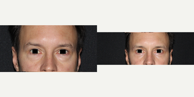 Eyelid Surgery before and after photo