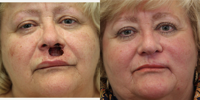 Facial Reconstructive Surgery before and after photo