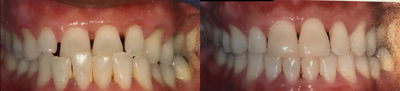 Invisalign before and after photo
