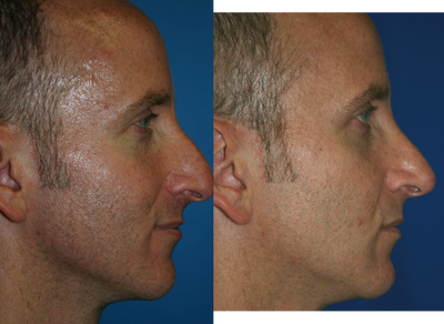 Rhinoplasty before and after photo