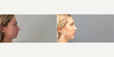 Rhinoplasty before and after photo