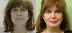 Facelift before and after photo