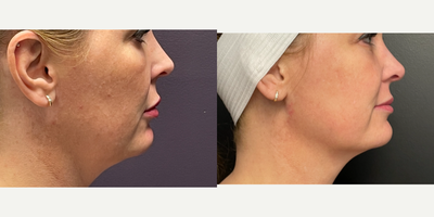 Chemical Peel before and after photo