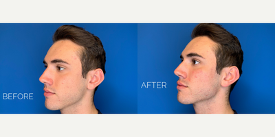 Dermal Fillers before and after photo