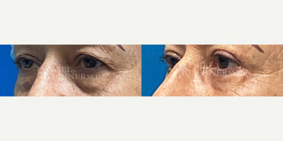 Double Eyelid Surgery before and after photo