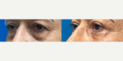 Double Eyelid Surgery before and after photo