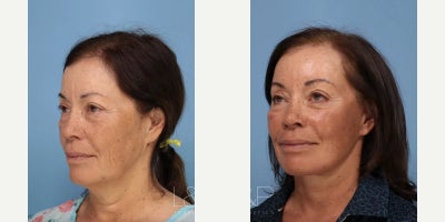 Facelift before and after photo