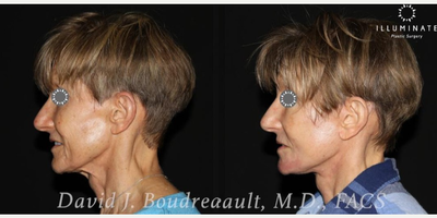 Neck Lift before and after photo