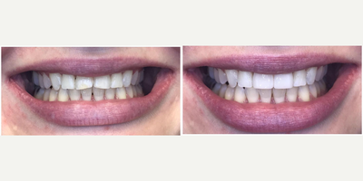 Dental Bonding before and after photo
