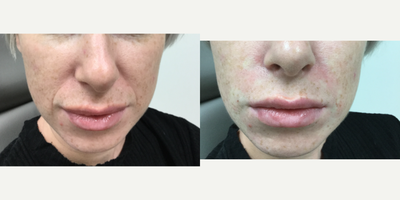 Dermal Fillers before and after photo