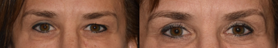 Eyelid Surgery before and after photo