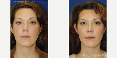 Eyelid Surgery before and after photo