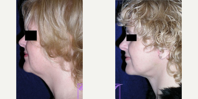 Facelift before and after photo