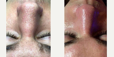 HydraFacial before and after photo