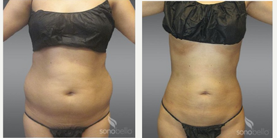 Laser Liposuction before and after photo