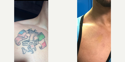 Tattoo Removal before and after photo