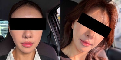 Thread Lift before and after photo